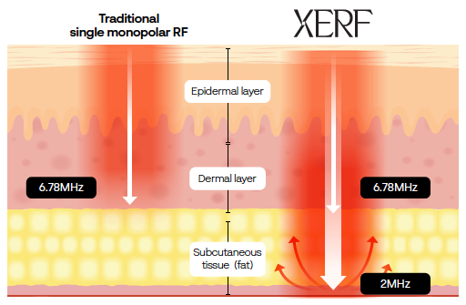 XERF dual-frequency RF for non-surgical skin tightening