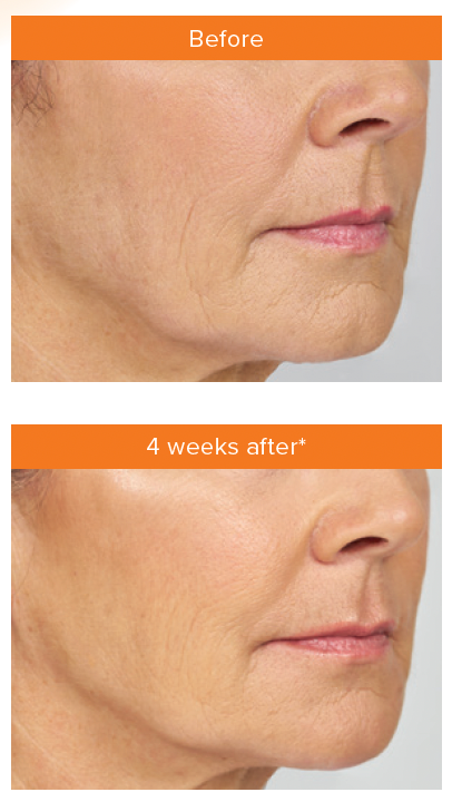 Dermal filler for laugh lines