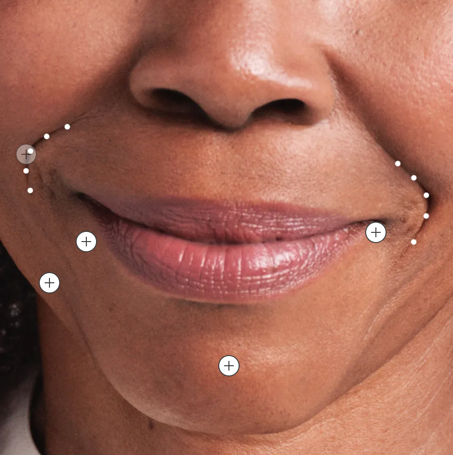 Radiesseand Sculptra collagen stimulating injections for laugh lines, chin and cheeks