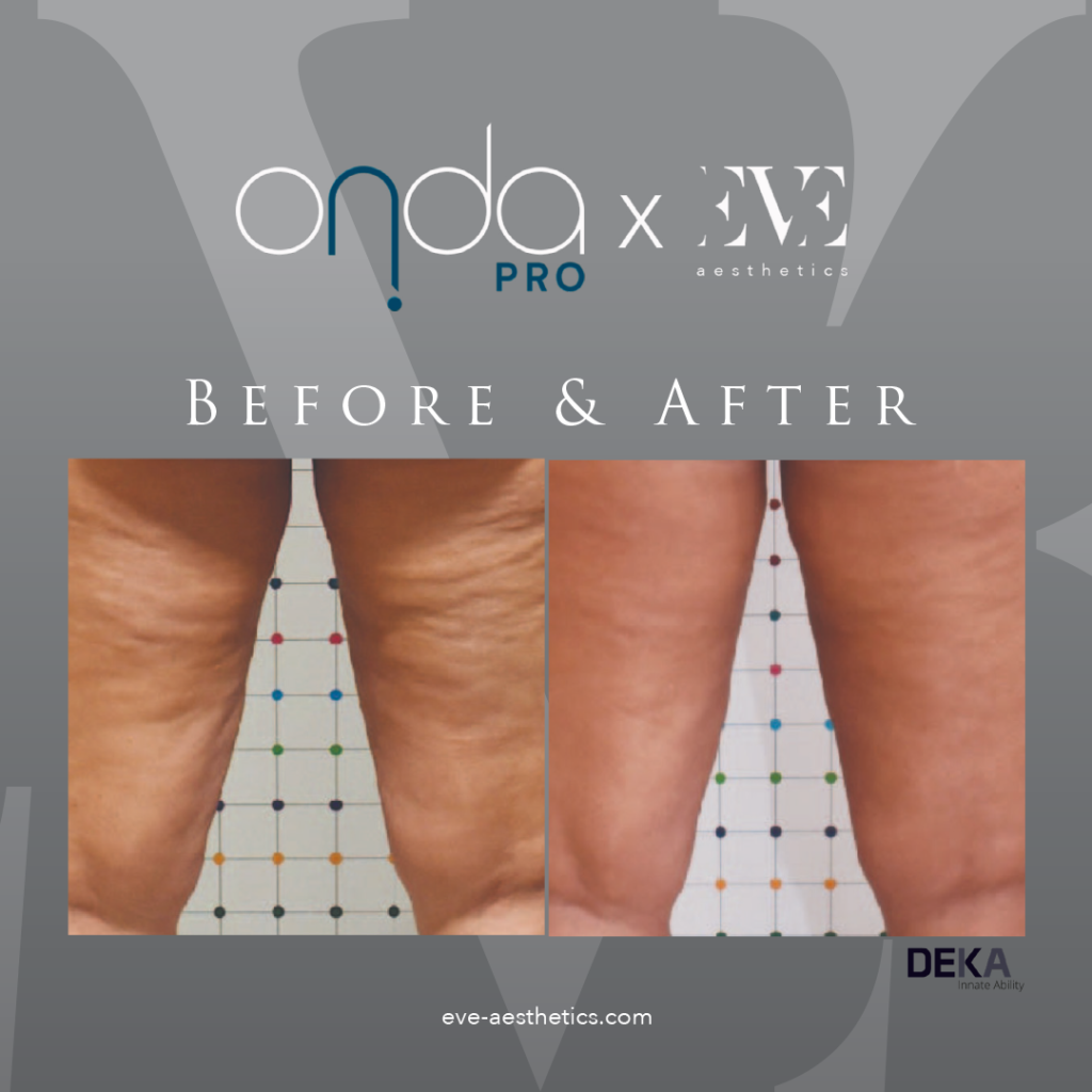 Onda-Pro_RESULTS_Before-After_01-2 – EVE Aesthetics