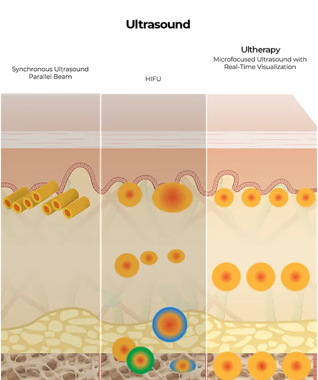 Infographic showing three ultrasound therapies: Synchronous Ultrasound Parallel Beam, HIFU, and Ultherapy with real-time visualization; cross-section of tissue and fat layers.
