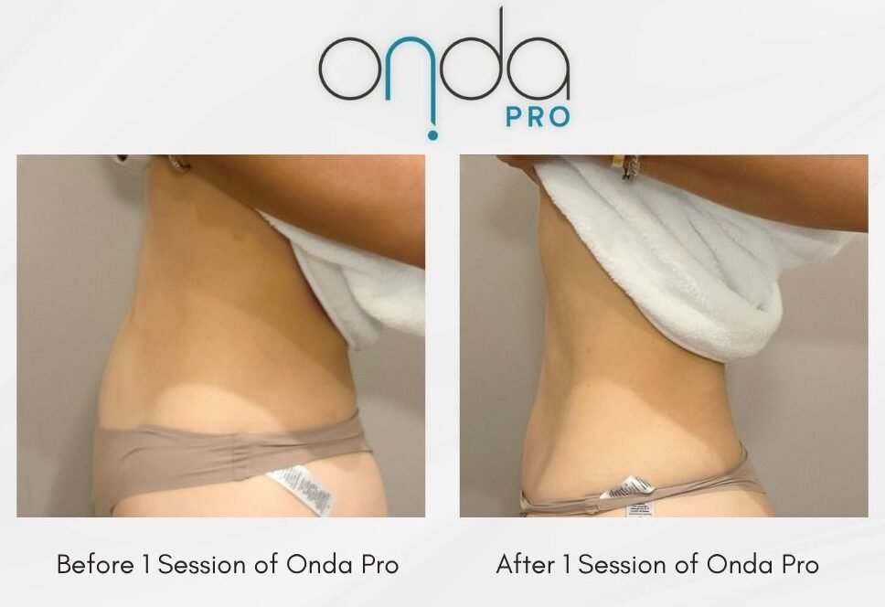 Onda Pro x EVE Results_03 – EVE Aesthetics Before and after comparison of Onda Pro treatment on the neck area, showing slight tightening after one session.