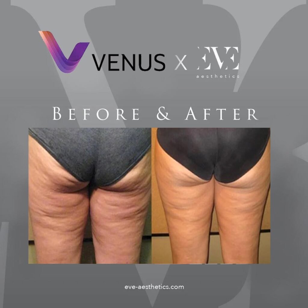 Venus_RESULTS_Before-After_01-2 – EVE Aesthetics Before and after comparison of a woman's buttocks and thighs showing smoother skin; branding for Venus x Eve Aesthetics on the image.