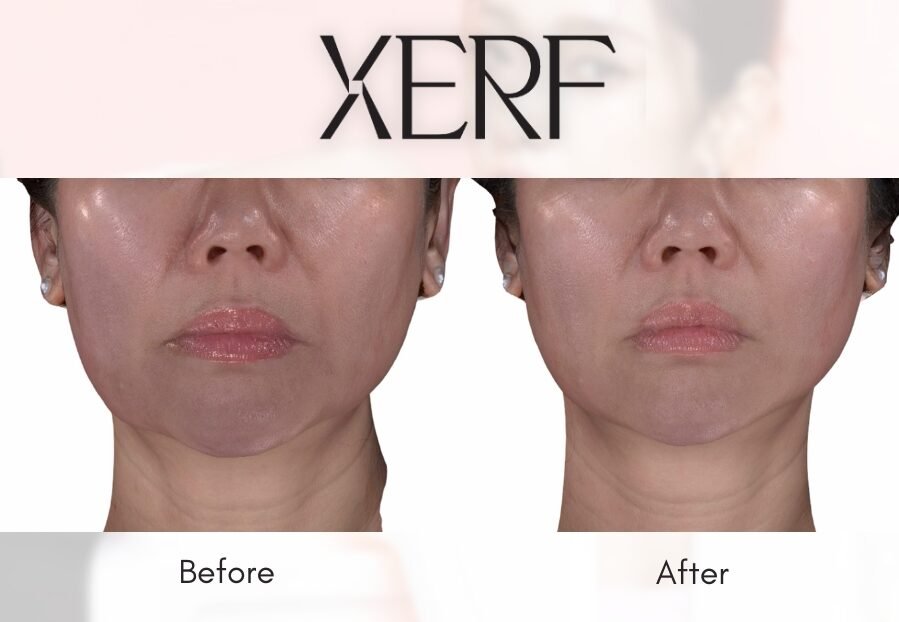 XERF x EVE Results_01 – EVE Aesthetics Side-by-side before and after facial treatment showing smoother jawline and cheeks, with XERF aesthetics branding at the top and'Before' on the left, 'After' on the right.