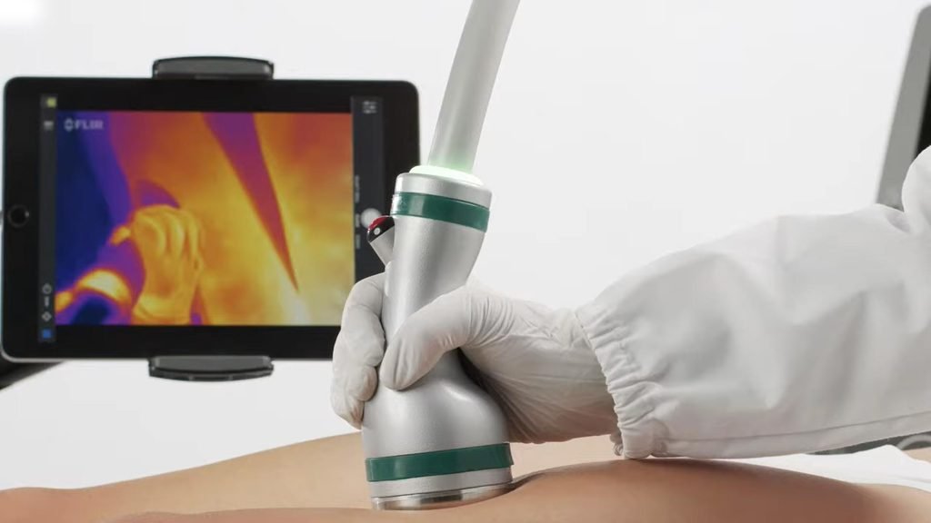 Onda Pro microwave treatment is comfortable and doesn't overheat skin - live temperature monitor