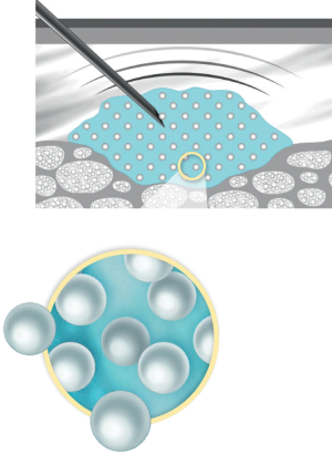 As opposed to Aesthefil and Sculptra, Radiesse provides immediate results